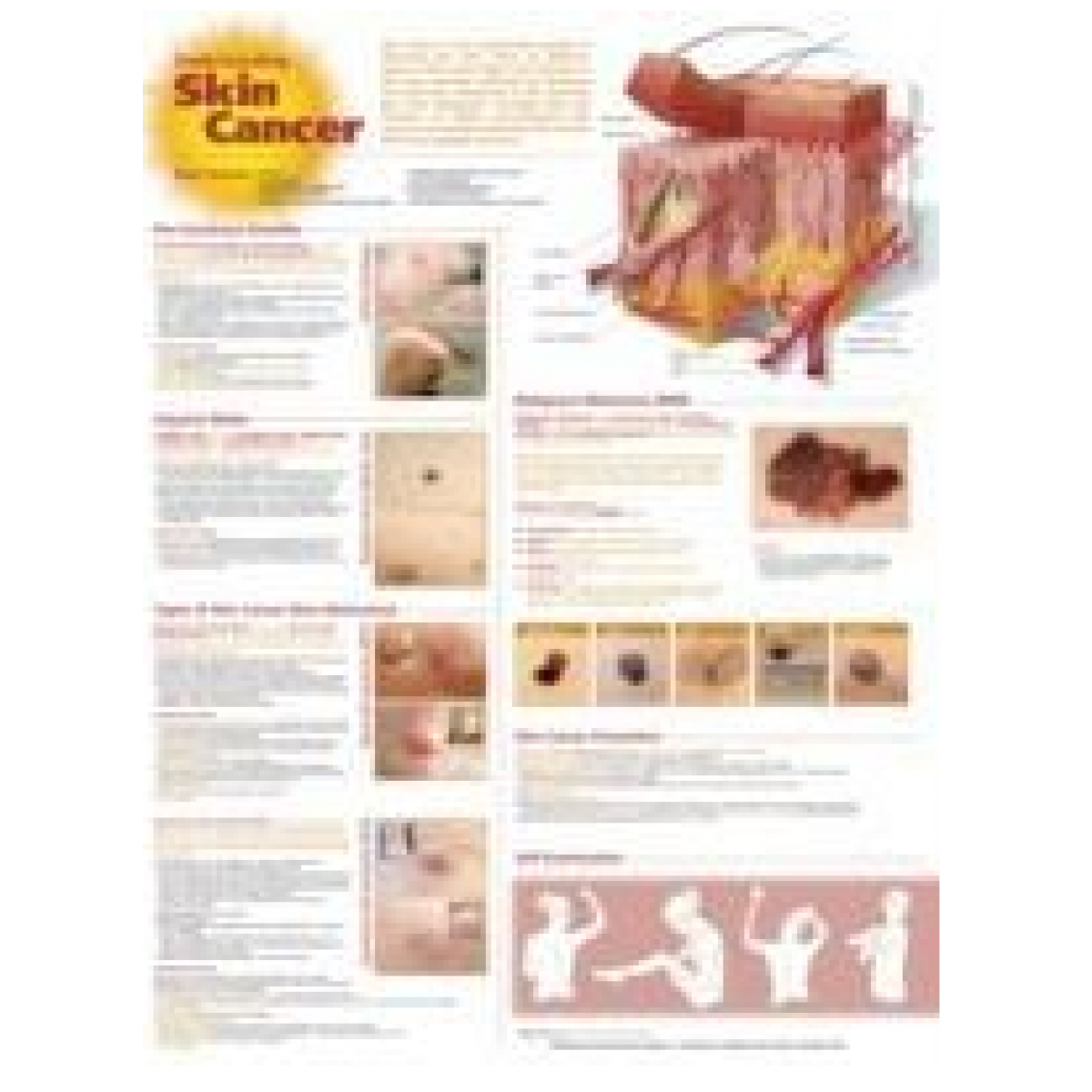 Anatomical Chart Company Understanding Skin Cancer Anatomical Chart