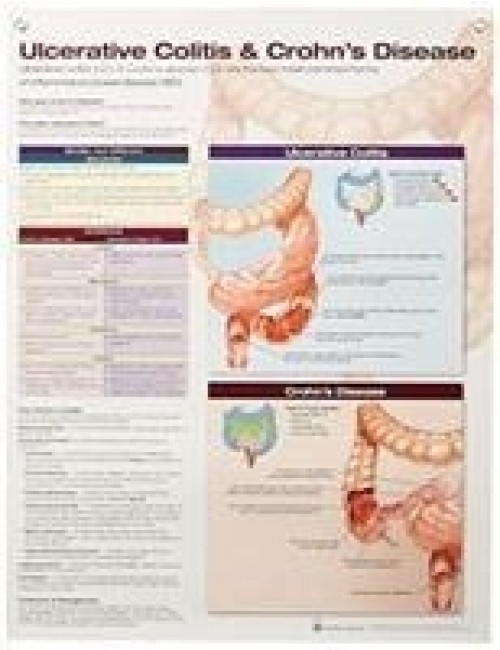 Anatomical Chart Company Ulcerative Colitis & Crohn's Disease School