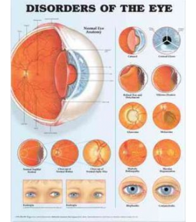 Anatomical Chart Company Disorders of the Eye Anatomical Chart